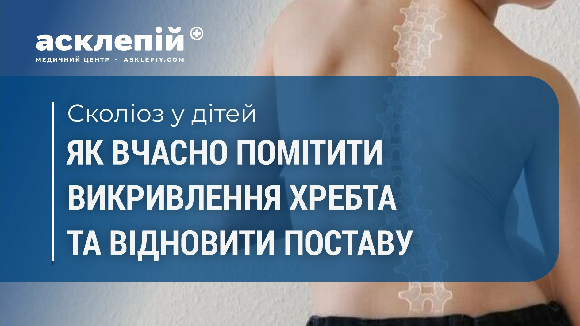 Сколіоз у дітей: як вчасно помітити викривлення хребта та відновити поставу
